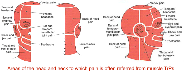 Tmj Orofacial Pain Treatment Centers Of Wisconsin Myofascial Pain Dysfunction